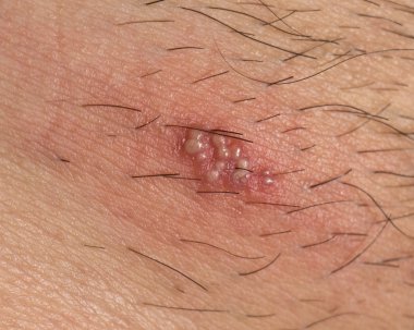 İnsan vücudunda Herpes