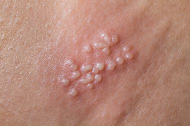 İnsan vücudunda Herpes