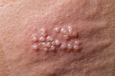İnsan vücudunda Herpes