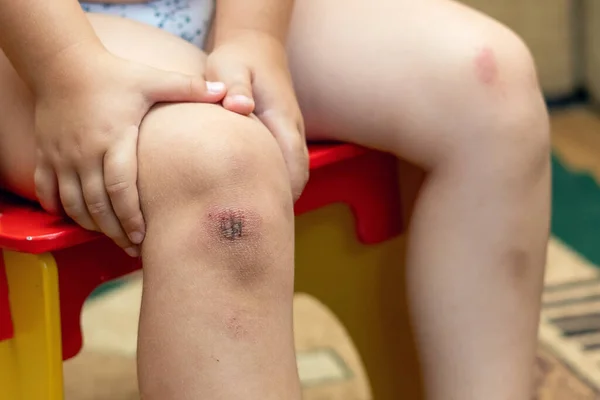 Painful knee injury, childhood injury, accident, child holding on to injured knee.
