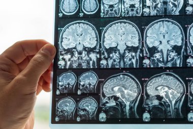 Doktor beynin MR görüntüsünü analiz ediyor..