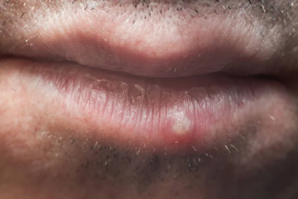 Infecção Pelo Vírus Herpes Homem Nos Lábios — Fotografia de Stock
