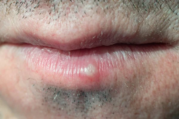 Infecção Pelo Vírus Herpes Homem Nos Lábios — Fotografia de Stock