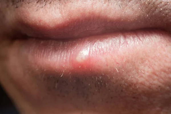 Infecção Pelo Vírus Herpes Homem Nos Lábios — Fotografia de Stock