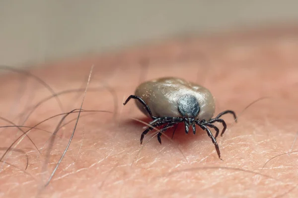 A tick drunk on blood crawls on human skin.