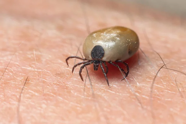 A tick drunk on blood crawls on human skin.