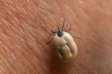 Kana bulanmış bir kene insan derisinde sürünür..