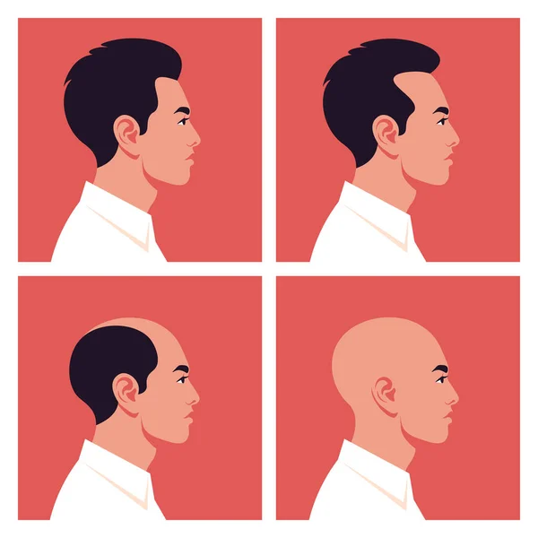 Phasen Männlicher Glatzenbildung Haarausfall Alopezie Profile Asiatischer Männer Vektorflache Illustration — Stockvektor