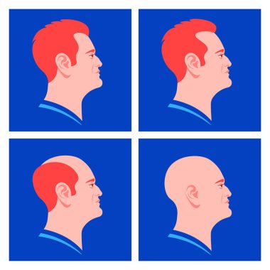 Erkeklerin kellik aşamaları. Saç dökülmesi. Alopecia. Avrupalı erkeklerin profilleri. Vektör Düz Çizim
