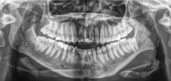 Panorámás röntgenkép a fogakról. — Stock Fotó