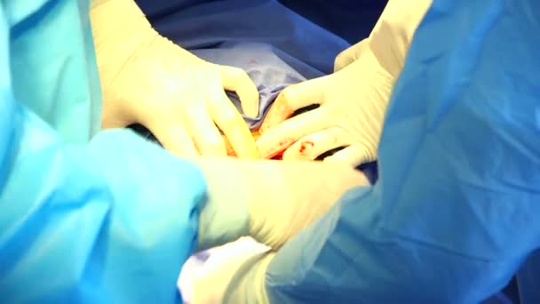 Χειρουργός κάνει καισαρική τομή — Αρχείο Βίντεο