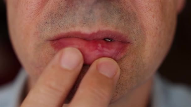 Úlceras Aftosas Recurrentes Aftas Labio Dolorido Estomatitis Aftosa Úlceras Bucales — Vídeos de Stock