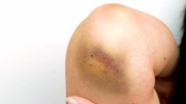 Geniş İyileştirme Çürüğünün Kapanışı ya da Parmağa Dokunulan Kolda Hematom