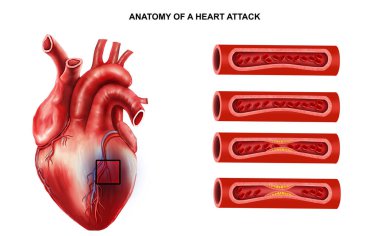  Kalp krizi anatomisinin tıbbi çizimi