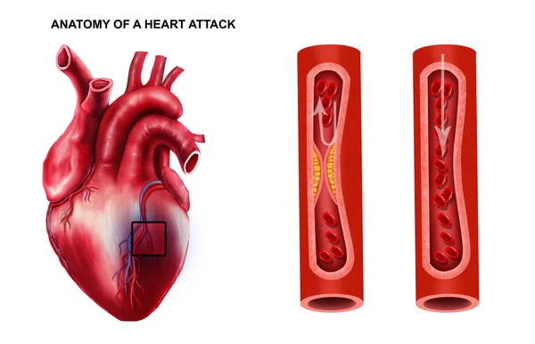 Medicinsk Illustration Anatomi Hjärtattack — Stockfoto