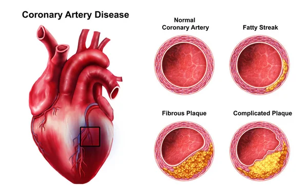 Medical Illustration Coronary Artery Disease — Stock Photo, Image