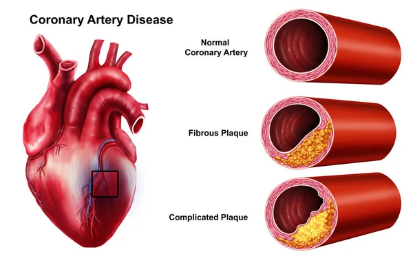 Ilustração Médica Doença Arterial Coronariana Coração — Fotografia de Stock