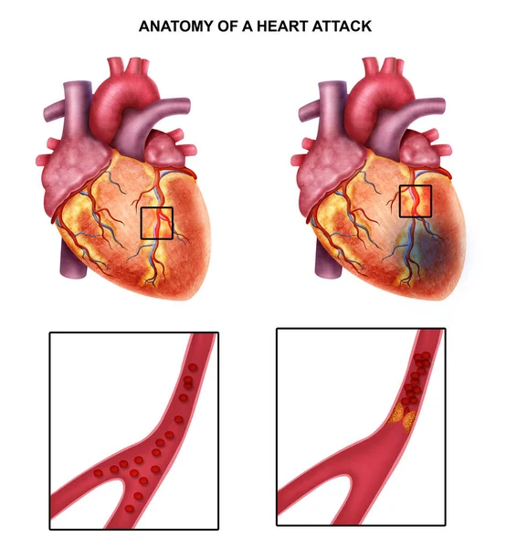 Medical illustration of  heart attack