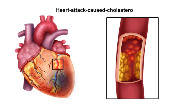 Ilustración Médica Ataque Cardíaco —  Fotos de Stock