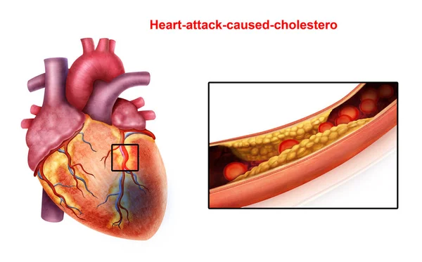 Ilustración Médica Ataque Cardíaco Causado Colesterol —  Fotos de Stock