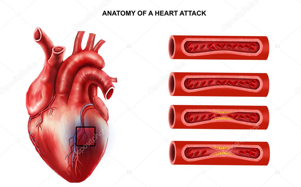  Medical illustration of  Anatomy of Heart Attack