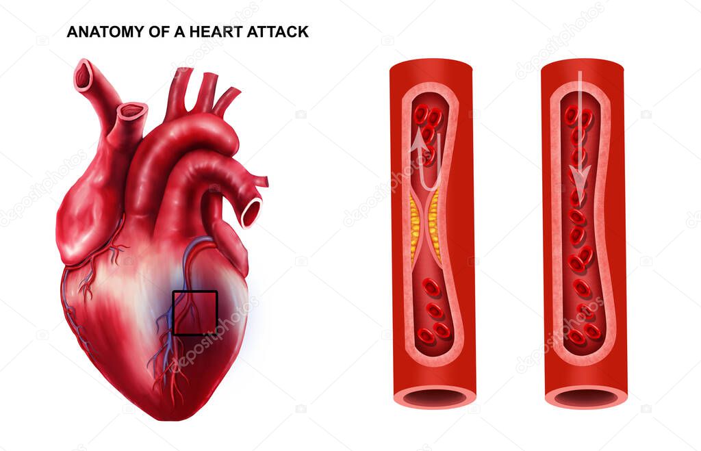  Medical illustration of  Anatomy of Heart Attack