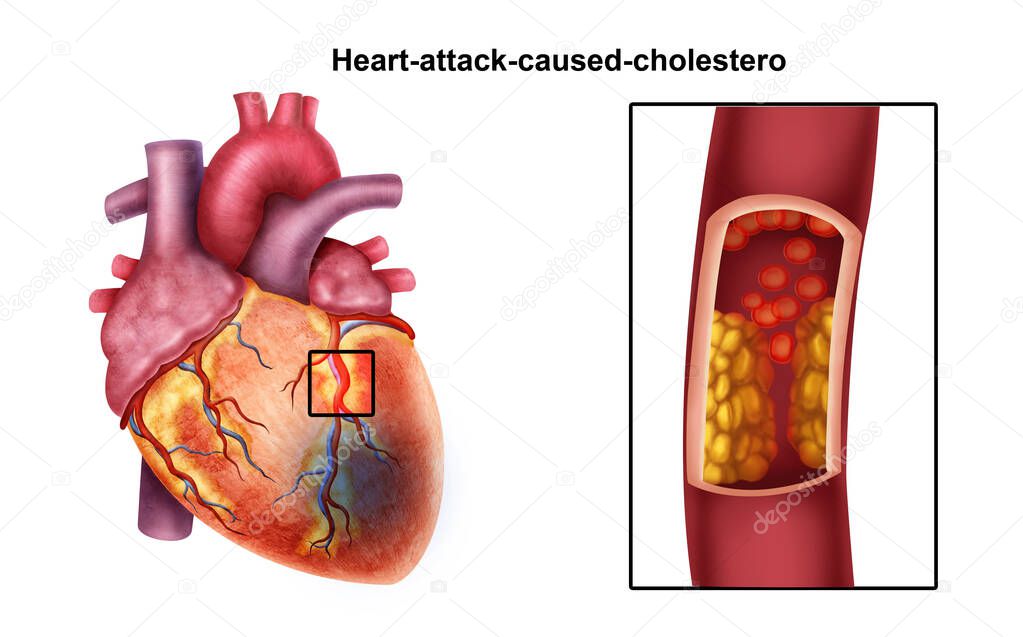  Medical illustration of  heart attack