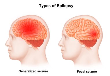 Medical illustration Types of epilepsy  clipart