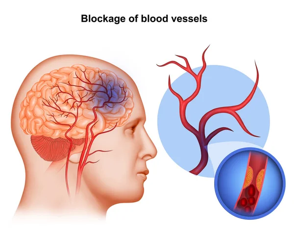 Ilustração Médica Bloqueio Das Artérias Cerebrais — Fotografia de Stock