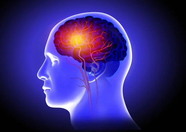 Ilustración Médica Del Bloqueo Las Arterias Cerebrales Humanas — Foto de Stock