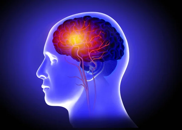 Medical illustration of Human brain arteries blockage