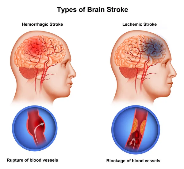 Ilustração Médica Dois Tipos Acidente Vascular Cerebral — Fotografia de Stock