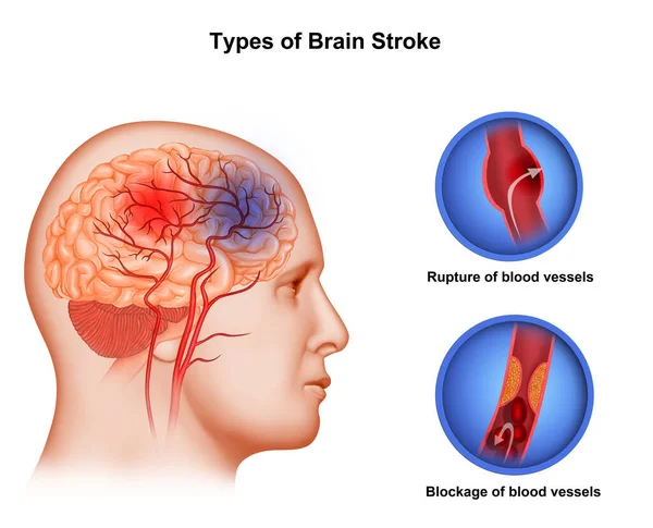 Ilustração Médica Tipos Acidente Vascular Cerebral — Fotografia de Stock