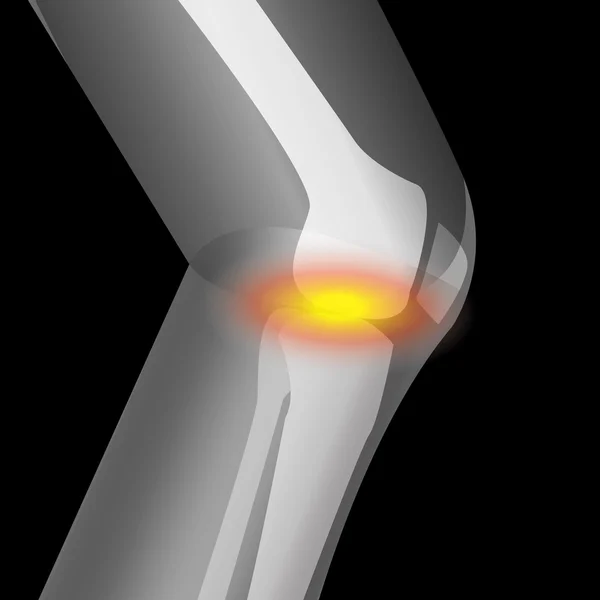 Артрит в колене, боль в колене, страдает от колена — стоковый вектор