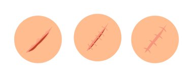 İnsan derisi kavramında yara iyileşme aşamaları. İyileşen yaralar, deri yaraları, dikişler ve kesikler. Gerçekçi cerrahi dikişler, farklı iyileşme aşamalarında dikişler. Vektör