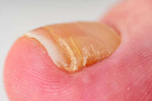 Toenail disease, big toe fungus, toenail erosion close up, health and medicine