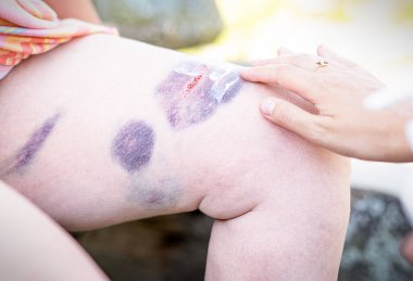 Bacağında çürük var, krem sürülmüş.