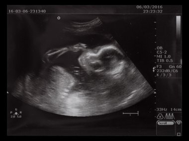 Doğmamış bebeğin resmini Ultrasonografi 