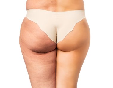 Cellulite problem concept, before and after clipart
