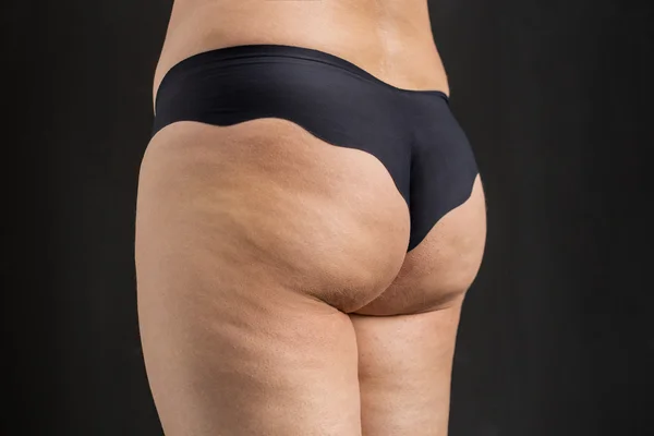 Cellulite problem — Stock Photo, Image