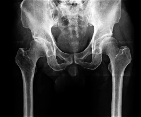 Imagen radiográfica de la cadera —  Fotos de Stock