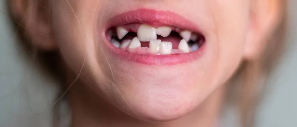 Mordida Errada Numa Criança Problema Dentes Crianças Imagens Royalty-Free