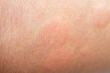 Cilt alerjisi isilik dermatit dokusu, arka planı kapatın.