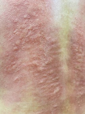 Genç Asyalı adam kaşınıyor ve sırtını kaşındırıyor alerjik kaşınıyor kuru cilt egzama dermatit böceği ısırıkları