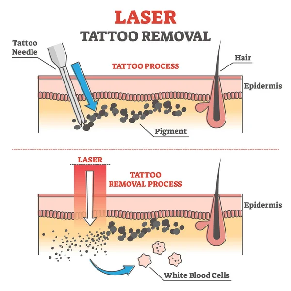 Laser tatuointi poisto prosessi merkitty koulutus selitys ääriviivat käsite — vektorikuva