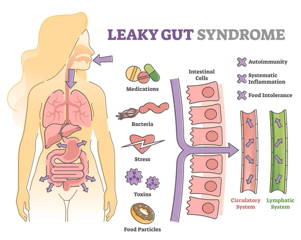 Leaky gut syndrome as immune system reaction to environment outline diagram — Wektor stockowy