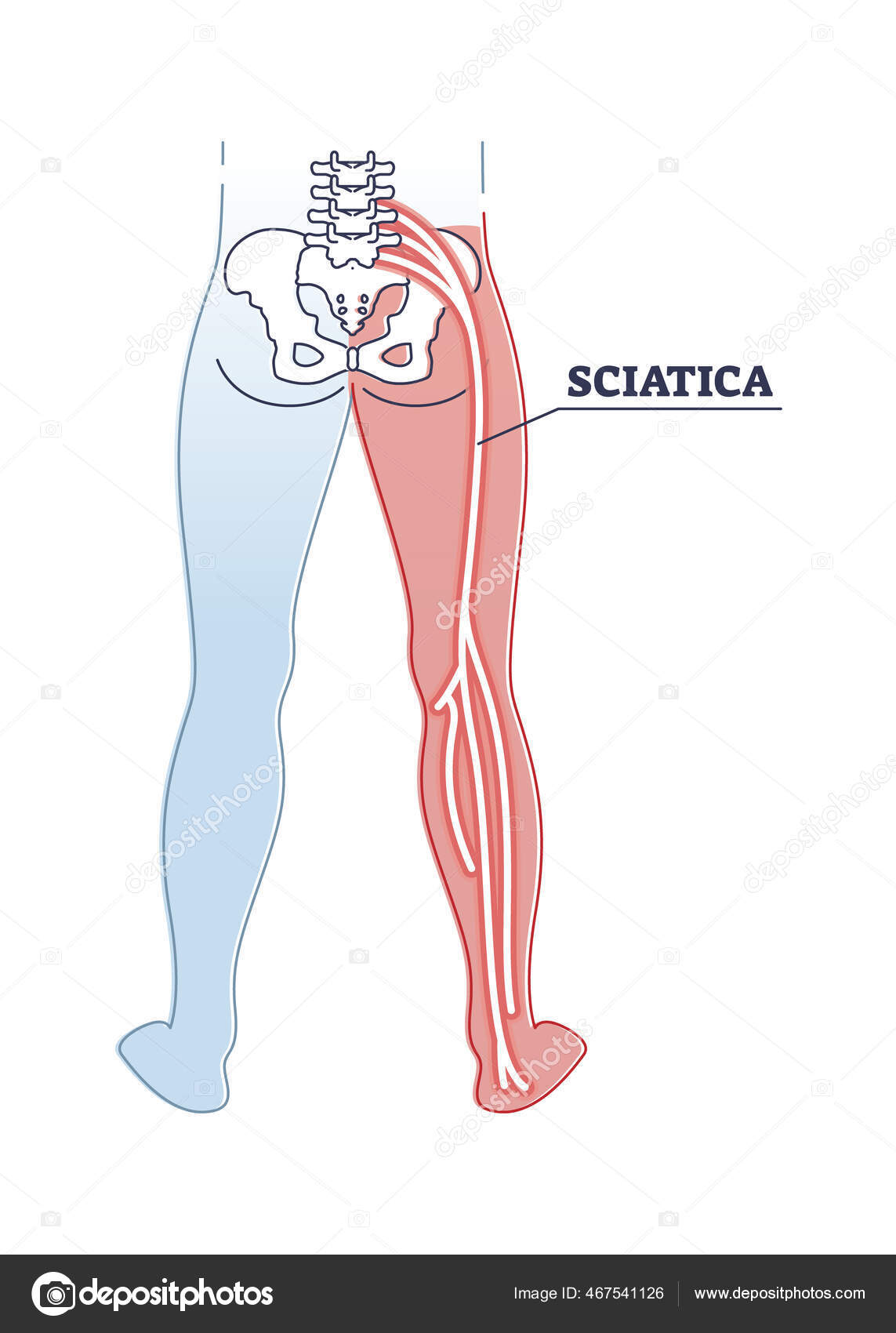 Sciatica pain or nerve weakness as leg lumbar radiculopathy outline