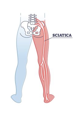 Sciatica pain or nerve weakness as leg lumbar radiculopathy outline diagram clipart
