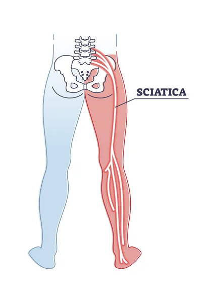 Sciatica pain or nerve weakness as leg lumbar radiculopathy outline diagram — 스톡 벡터