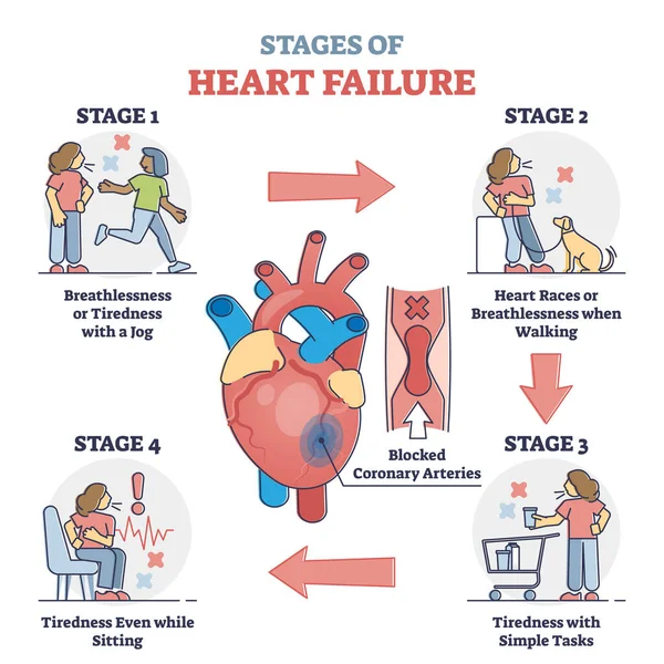 心脏衰竭的各个阶段及与心脏病理学中风示意图有关的症状 — 图库矢量图片